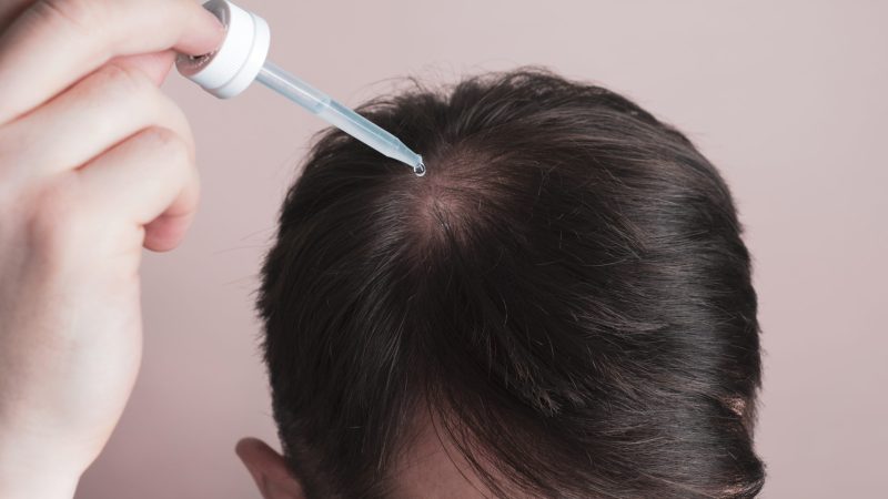 Hair loss problem. Man applying dropper with minoxidil or serum. Hair loss problem. Man applying dropper with minoxidil or serum.